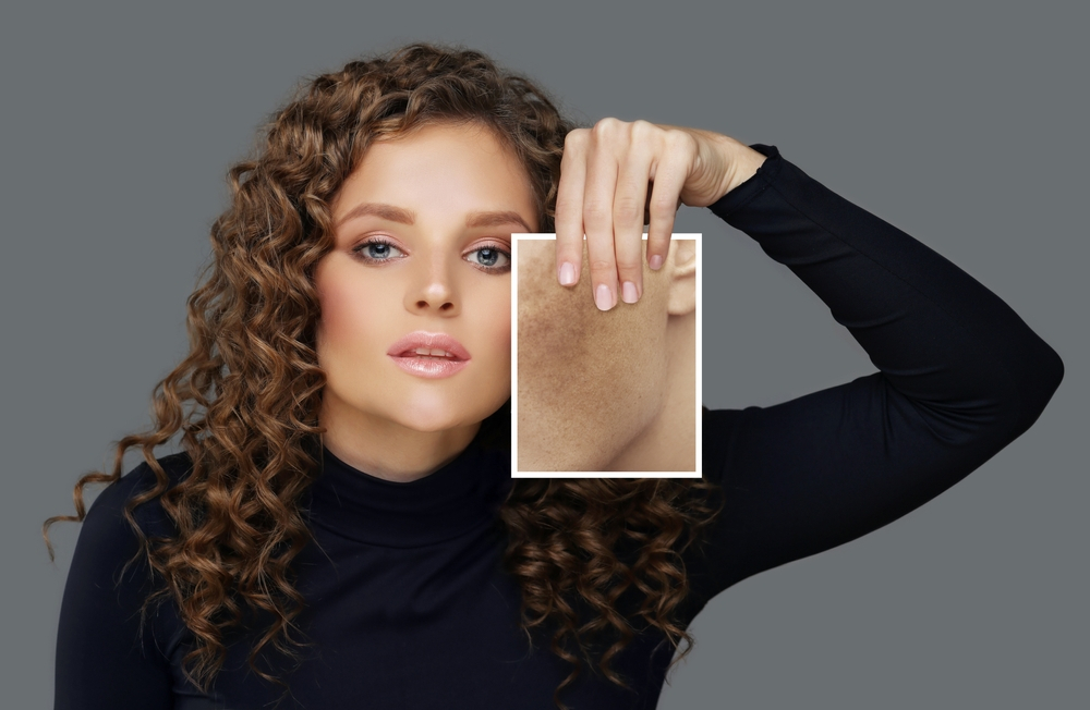 A woman with curly hair wearing a black top holds up an enlarged close-up image of skin showcasing hyperpigmentation and freckles next to her face, set against a plain gray background.