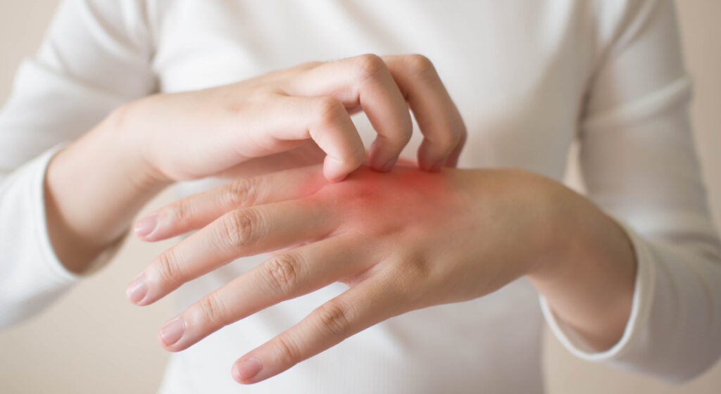A person wearing a white long-sleeve shirt scratches the back of their inflamed, red hand, possibly indicating eczema or an allergic reaction.