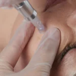Close-up of a person receiving a facial treatment, combining microdermabrasion with micro-needling. A gloved hand uses a small, metallic tool on the person's cheek. Their eyes are closed, and their skin looks smooth and calm.