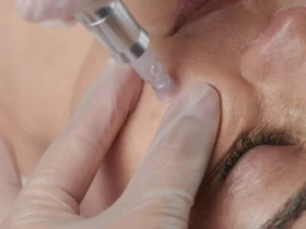 Close-up of a person receiving a facial treatment, combining microdermabrasion with micro-needling. A gloved hand uses a small, metallic tool on the person's cheek. Their eyes are closed, and their skin looks smooth and calm.