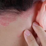 Close-up of the back of a person's head reveals red, scaly patches characteristic of psoriasis, extending from the scalp to the neck. A hand gently touches the affected area near the ear, suggesting irritation or discomfort.